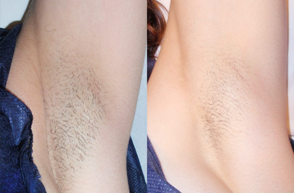 Effective removing hair with the help of innovative cosmetic manipulation