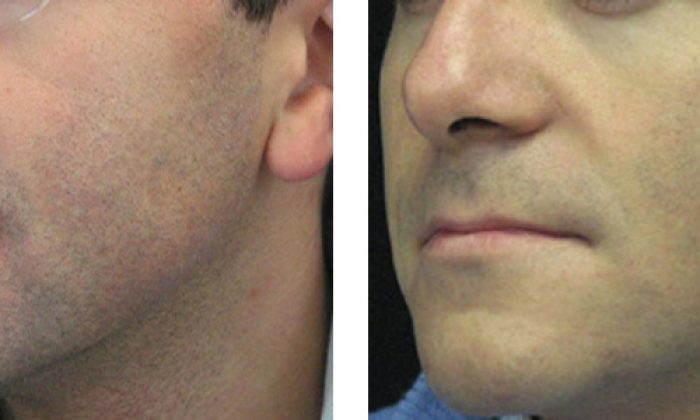 Removing hair in the face area with the help of highly technological laser equipment