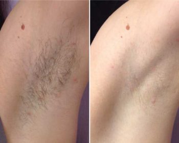 Why using laser equipment is the best way of removing hair