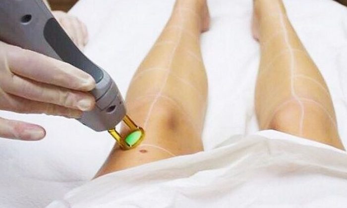 Using laser equipment for removing hair on legs: quickly and effectively